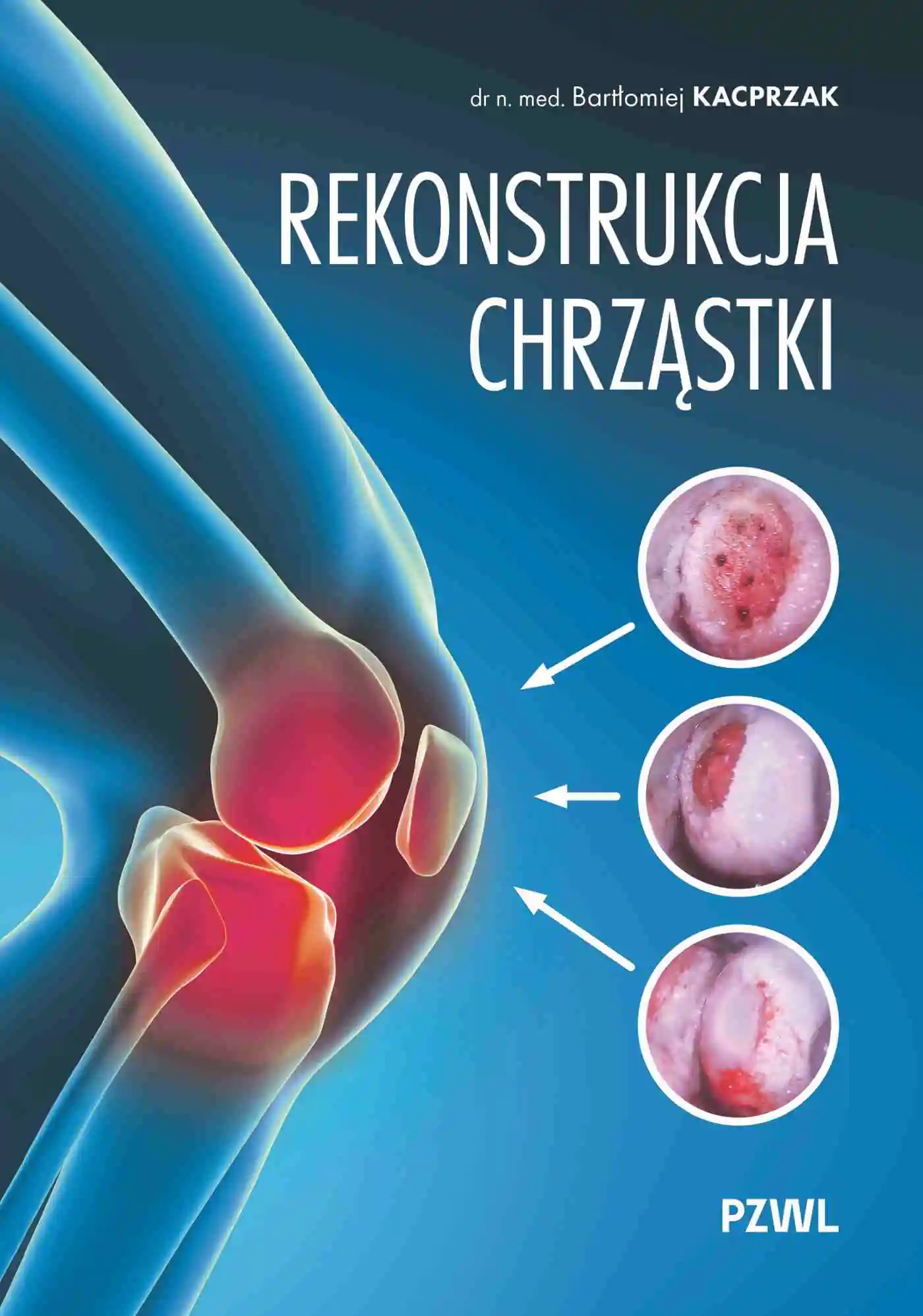 Książka - Rekonstrukcja chrząstki. Ratujemy kolano, nie wymieniamy